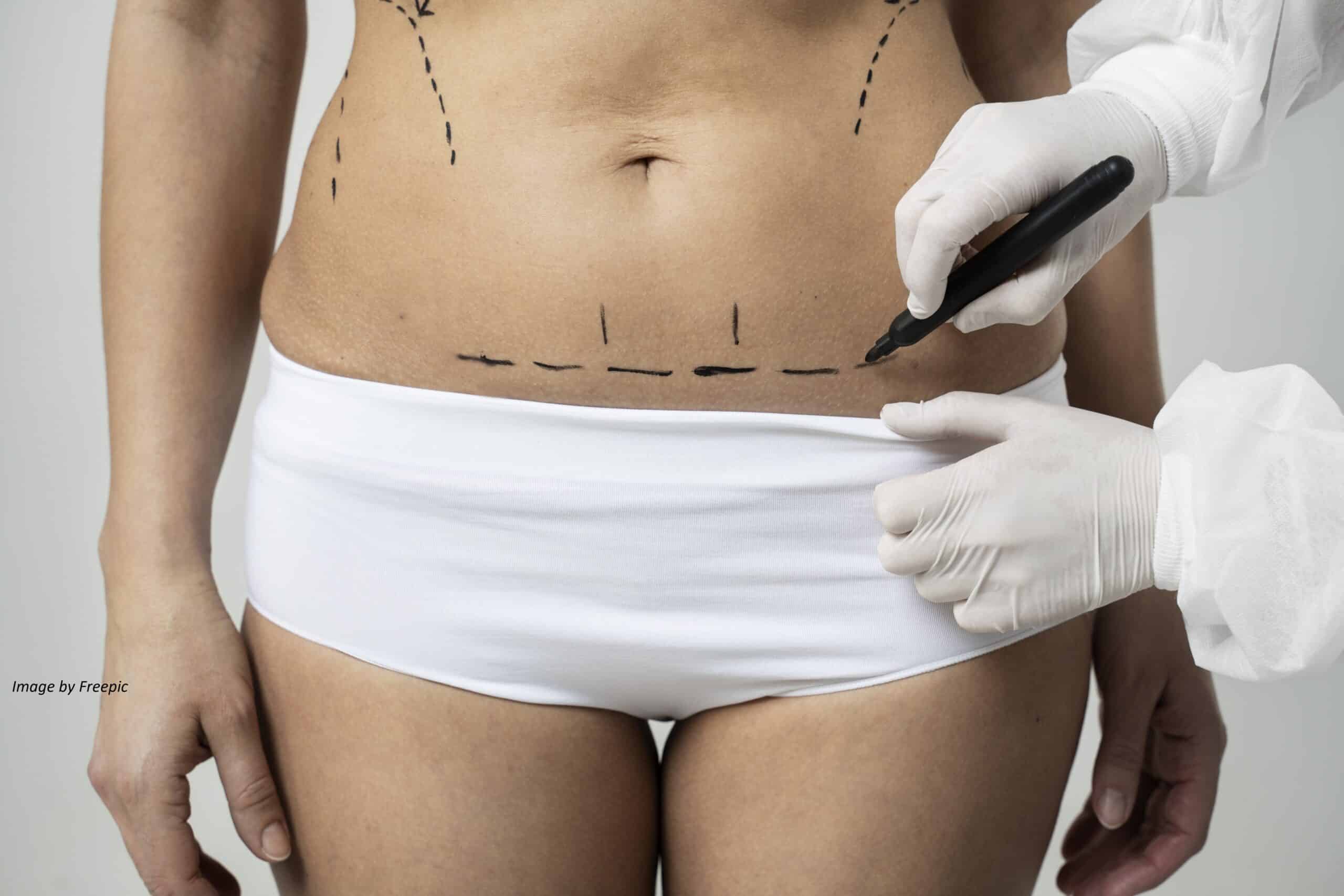 A woman is getting her tummy cut.