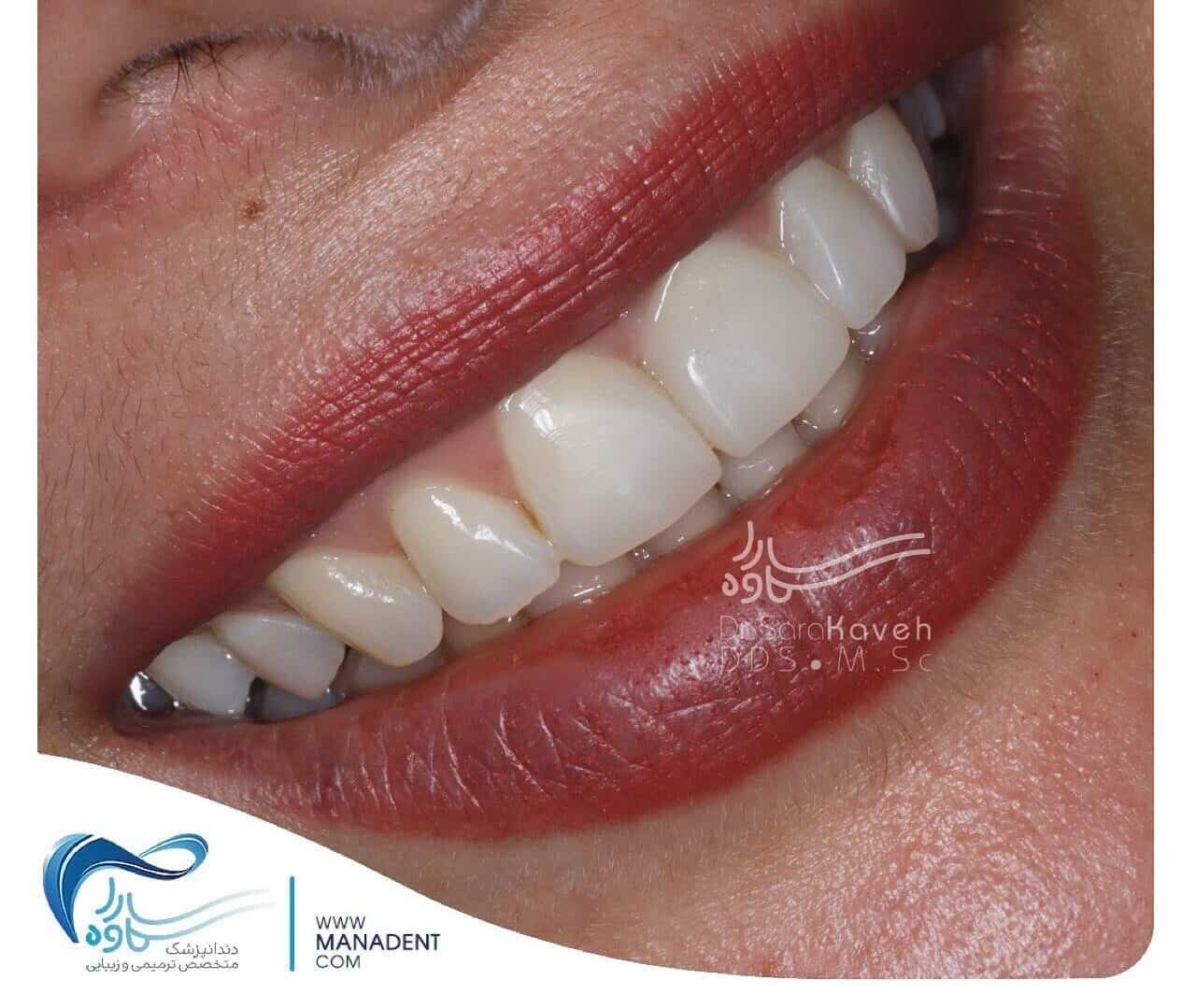 Hollywood Smile by Dr Sara Kaveh