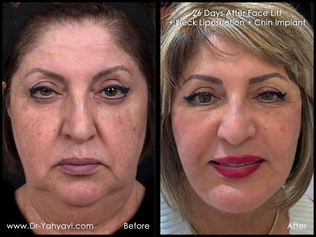 Before-After images by Dr Shahriyar Yahyavi
