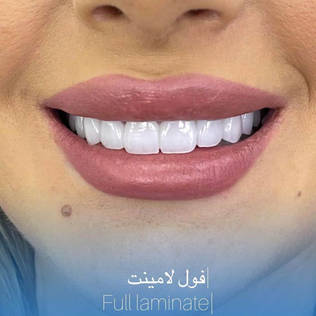 Smile makeover by dr movafagh fooladgar