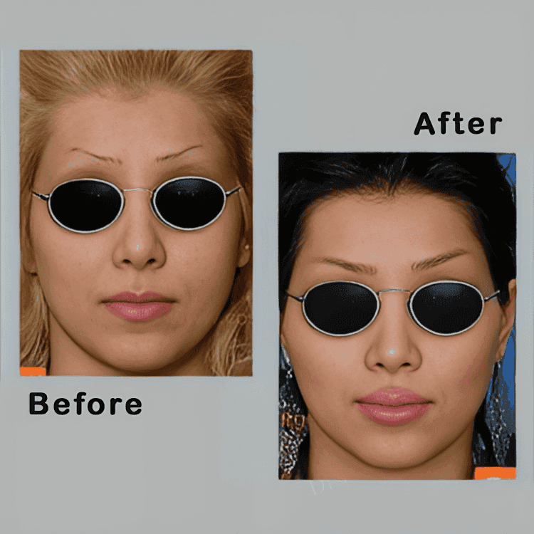 Dr Ali Manafi Rhinoplasty (Nose job) before and after photos