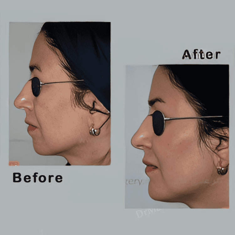 Dr Ali Manafi Rhinoplasty (Nose job) before and after photos2