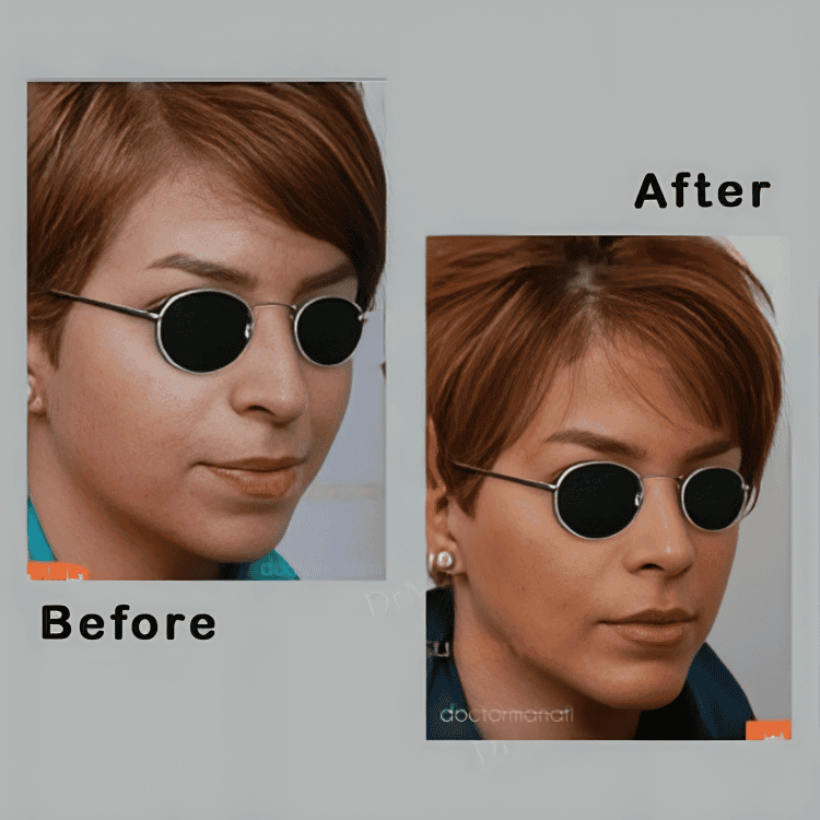 Dr Ali Manafi Rhinoplasty (Nose job) before and after photos3