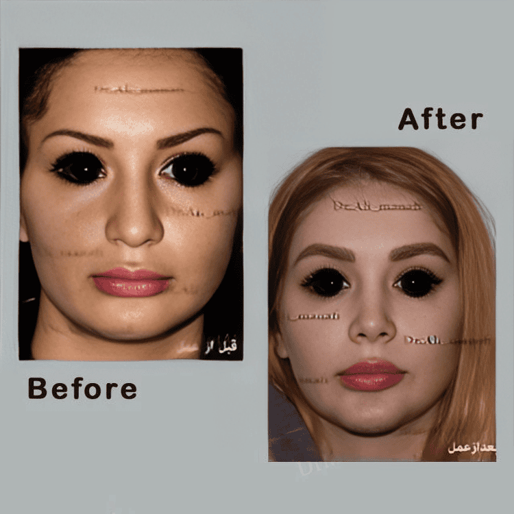 Dr Ali Manafi Rhinoplasty (Nose job) before and after photos5