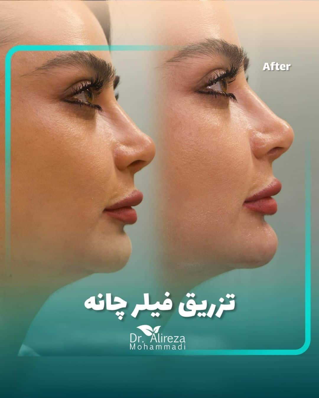 Cheek Augmentation by Filler-Dr Alireza Mohammadi