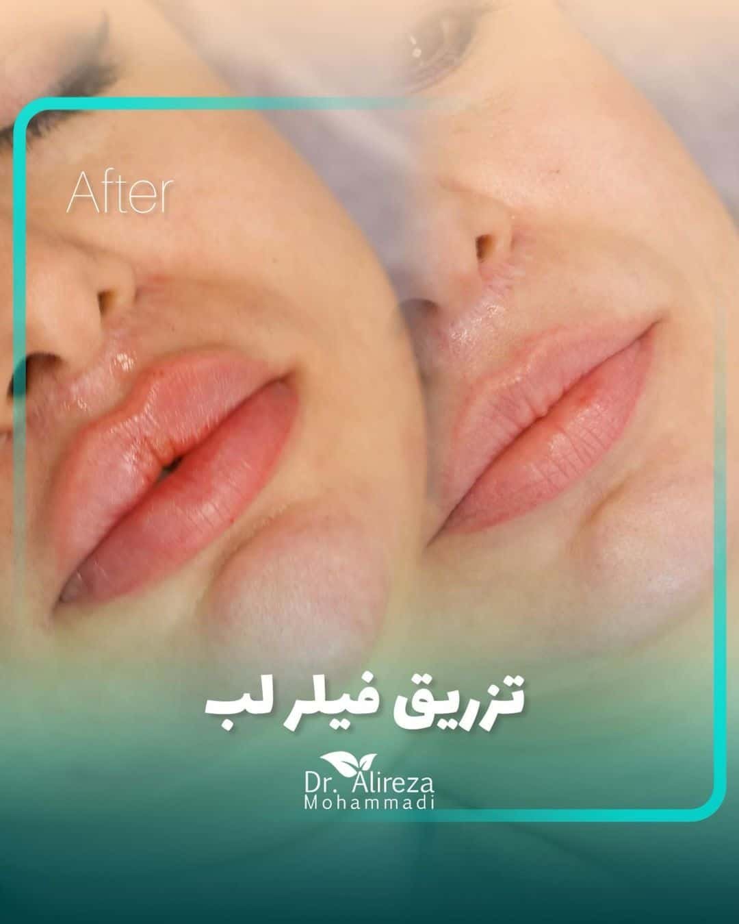 Lip Filler