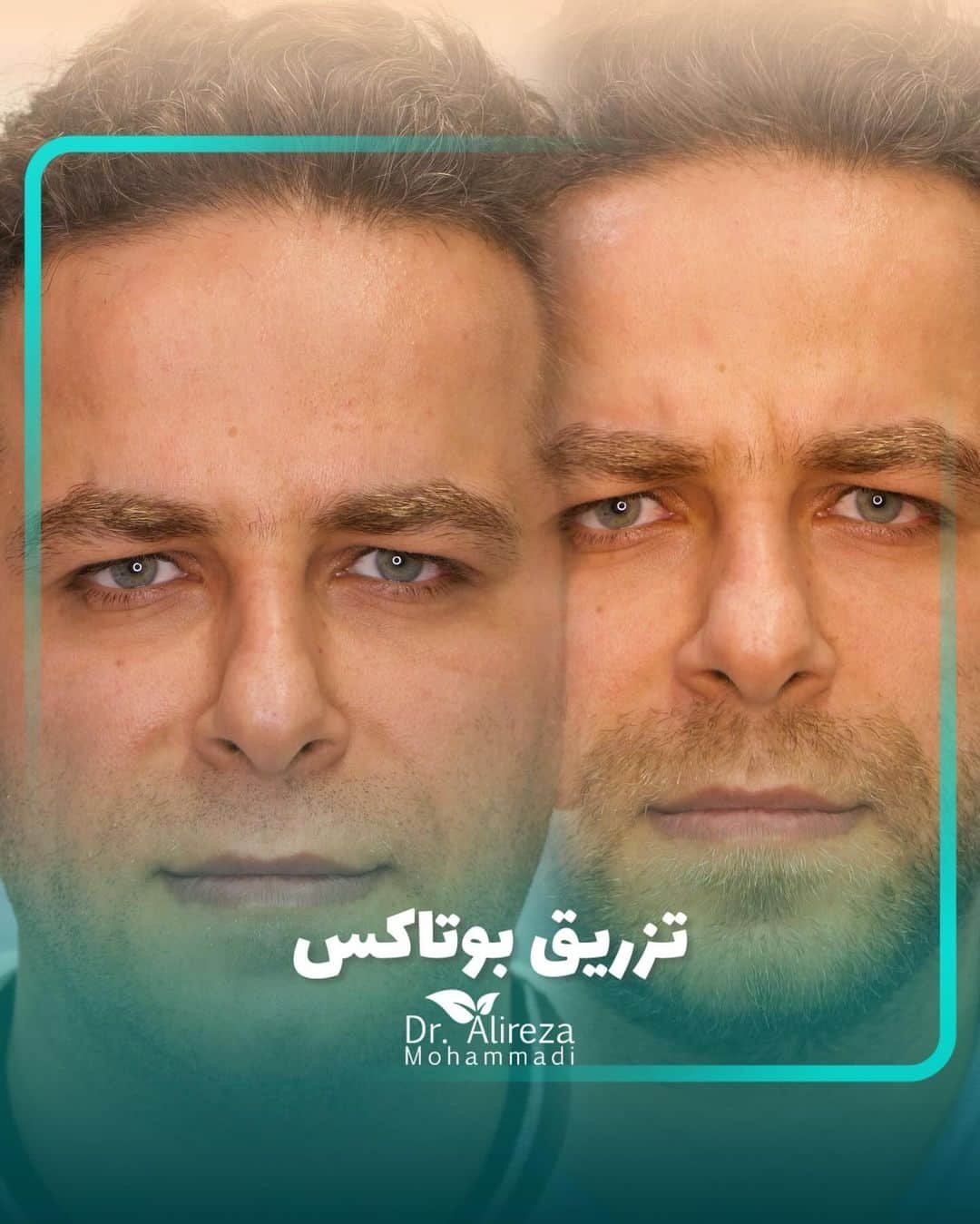 Botox Injection by Dr Alireza Mohammadi Beauty Expert in Tehran