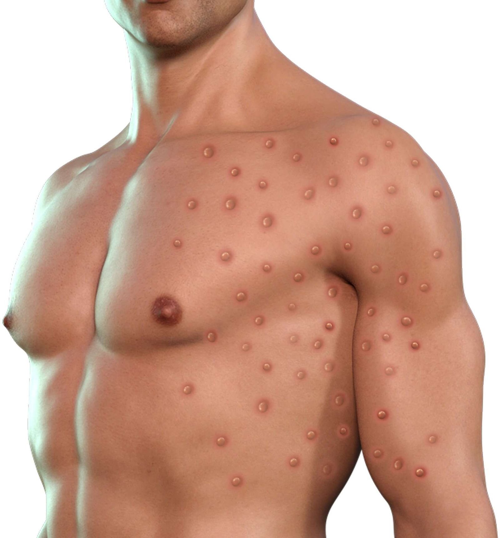 body of a young man with MPOX Symptoms