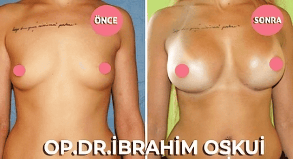 Breast lift in Istanbul by Dr Ibrahim Oskui