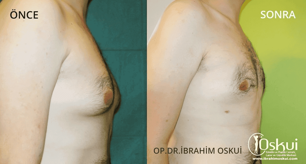 Gynecomastia Surgery in Istanbul with Dr Ibrahim Oskui