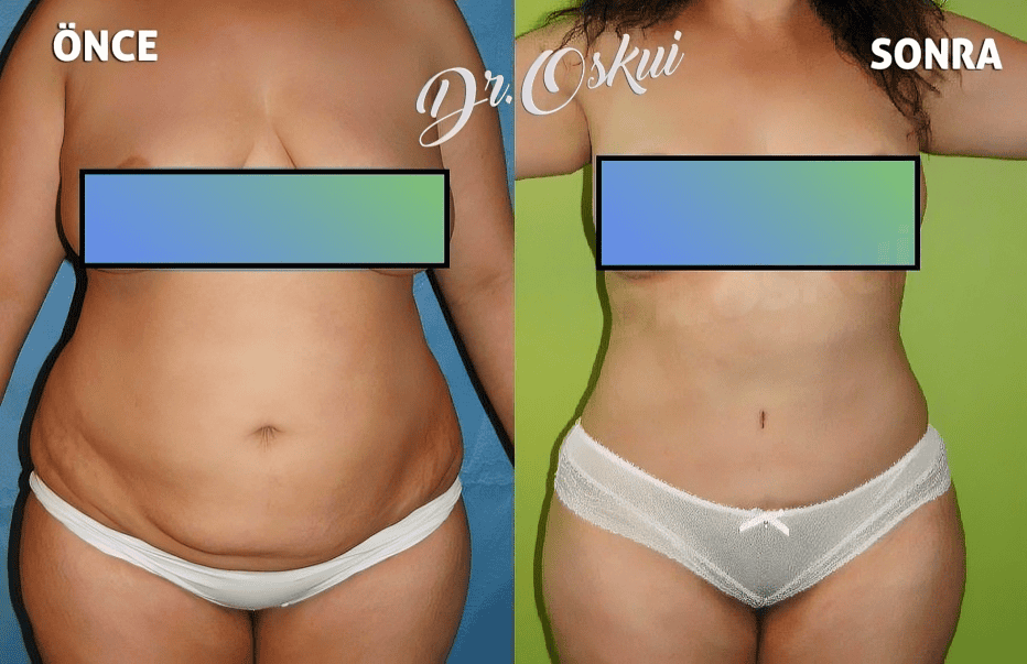 Liposuction in Istanbul by Dr Ibrahim Oskui