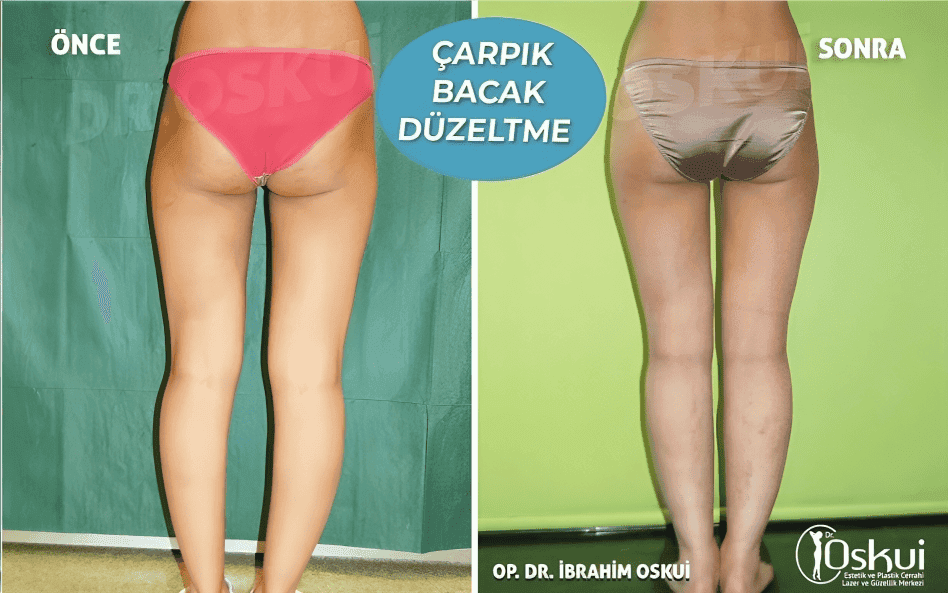 Crooked leg correction in Istanbul by Dr Ibrahim Oskui